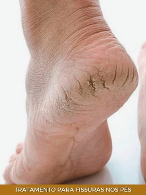 tratamento-para-fissuras-nos-pés-min