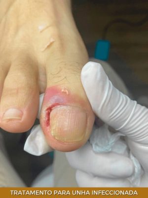 tratamento-para-unha-infeccionada-min